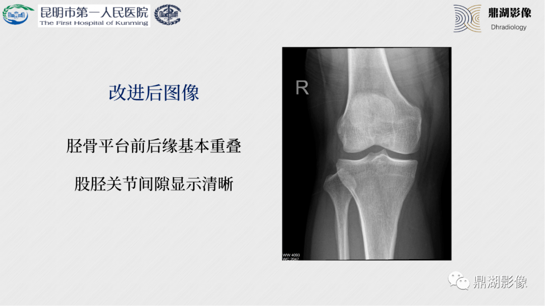 如何拍出完美的膝关节x线片这些经验太重要了