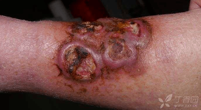 部分近期溃烂,伴颜面新发结节,斑块,偶发热,夜间多汗.患者:男,81 岁.