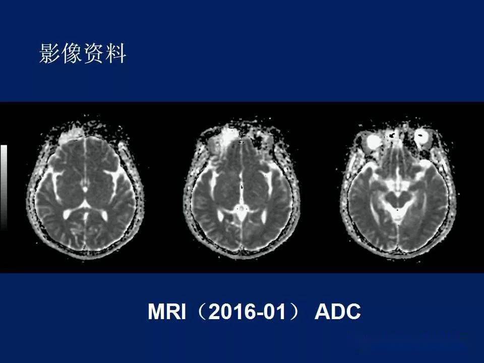 melas型线粒体脑病_工人医院