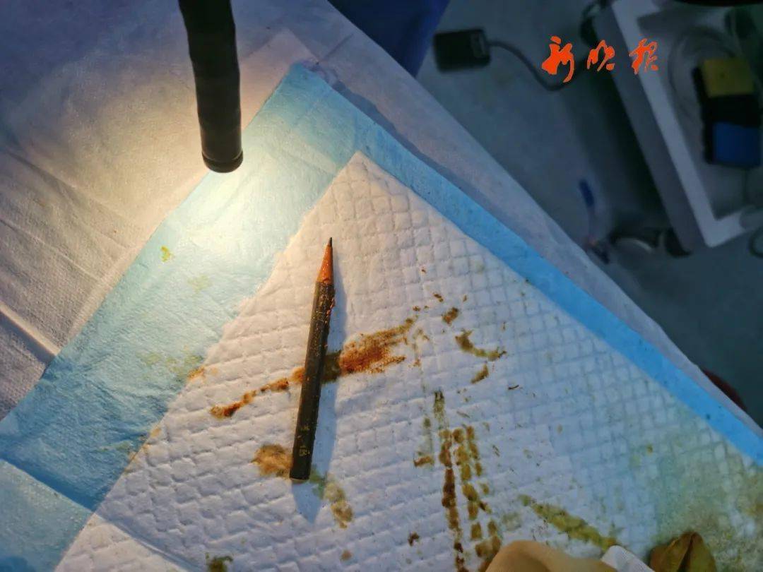 12岁哈尔滨男孩把10厘米铅笔塞进肛门,在体内走了80厘米_异物