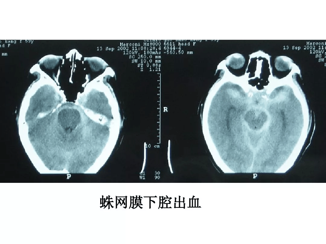 影像总结头颅ct基本知识与常见病变
