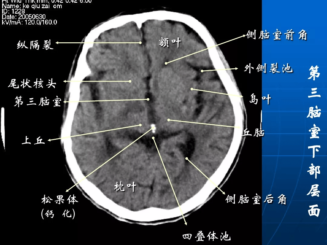 头颅ct解剖层次结构图图片