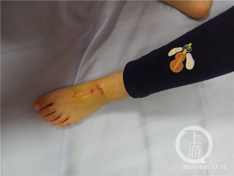 小女孩在商场厕所摔了一跤,竟然被"神秘液体"灼伤