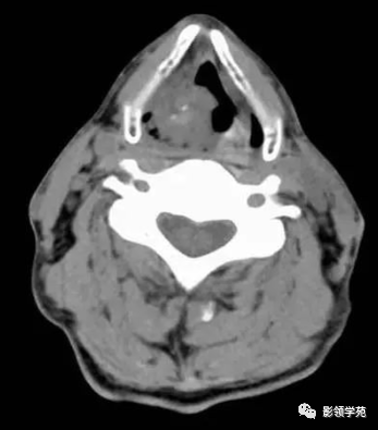 喉结癌图片图片
