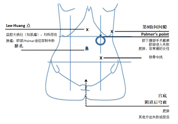 腹腔穿刺 图解图片