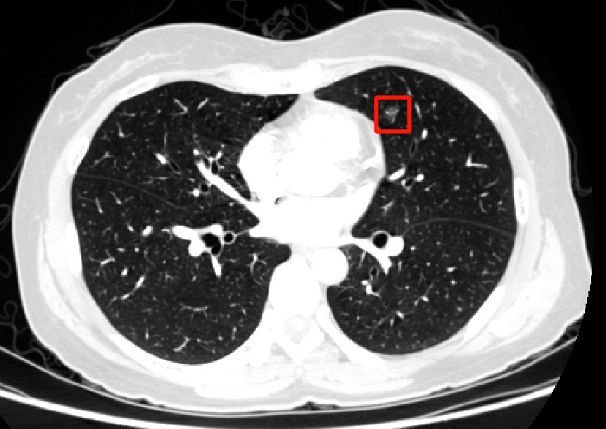 【健康】体检报告上有"肺小结节"怎么办?我是不是得癌了?专家这样说!