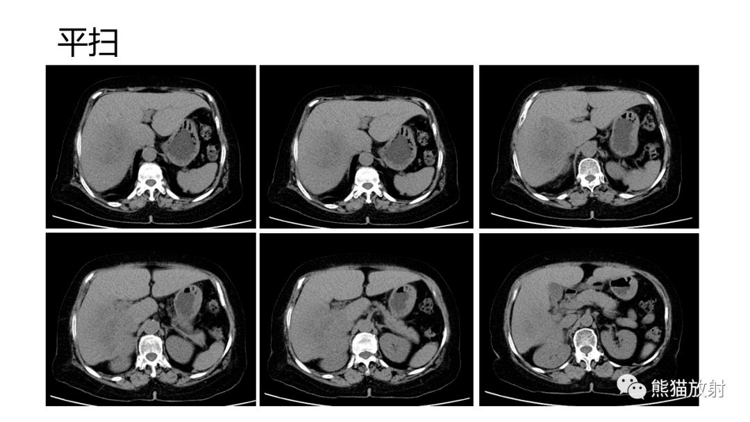 什么才叫持续发烧 cc2d45c230ef45bf9dd02e70ee71c7ce.png