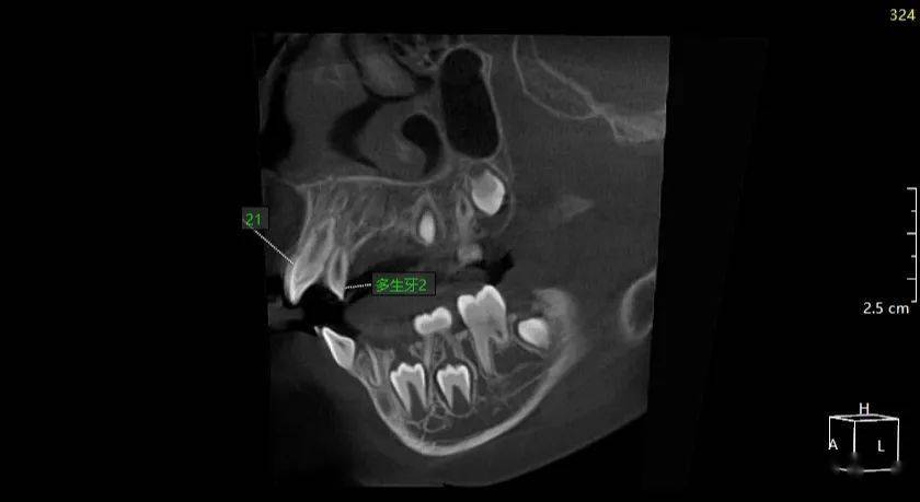 多生牙全景片图片