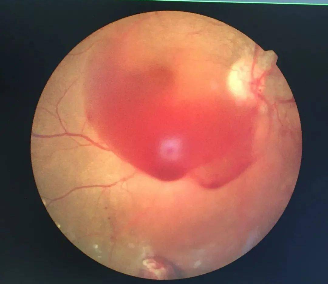 钟良玉看过检查报告,发现小婷的情况确实更严重了:右眼玻璃体积血合并