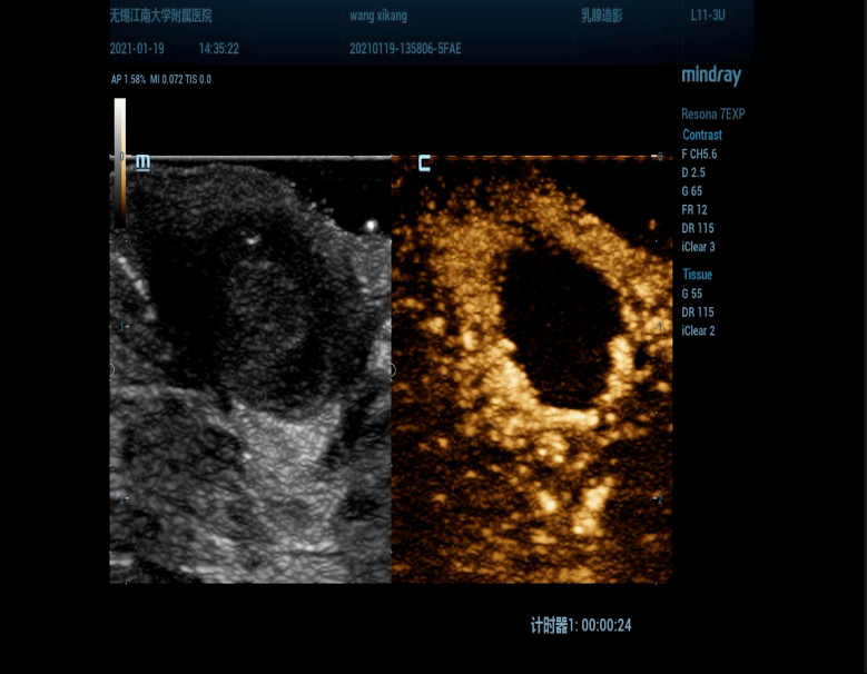 乳腺炎常見,但乳頭炎性病變你遇到過沒有?