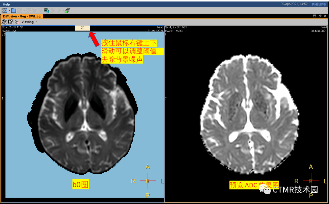 手把手教你基础颅脑mr平扫及后处理