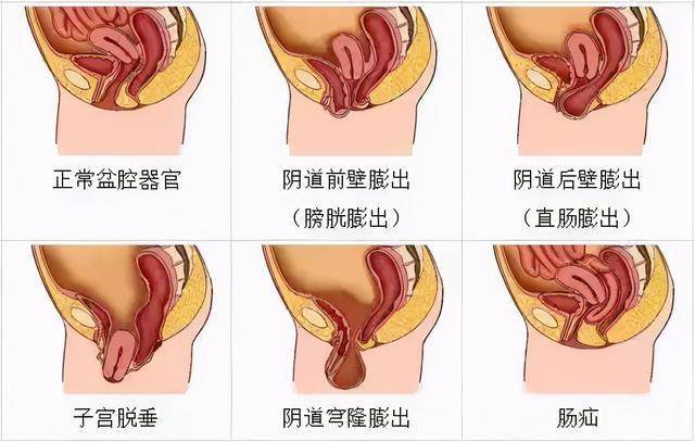 女性膀胱灌注流程图片