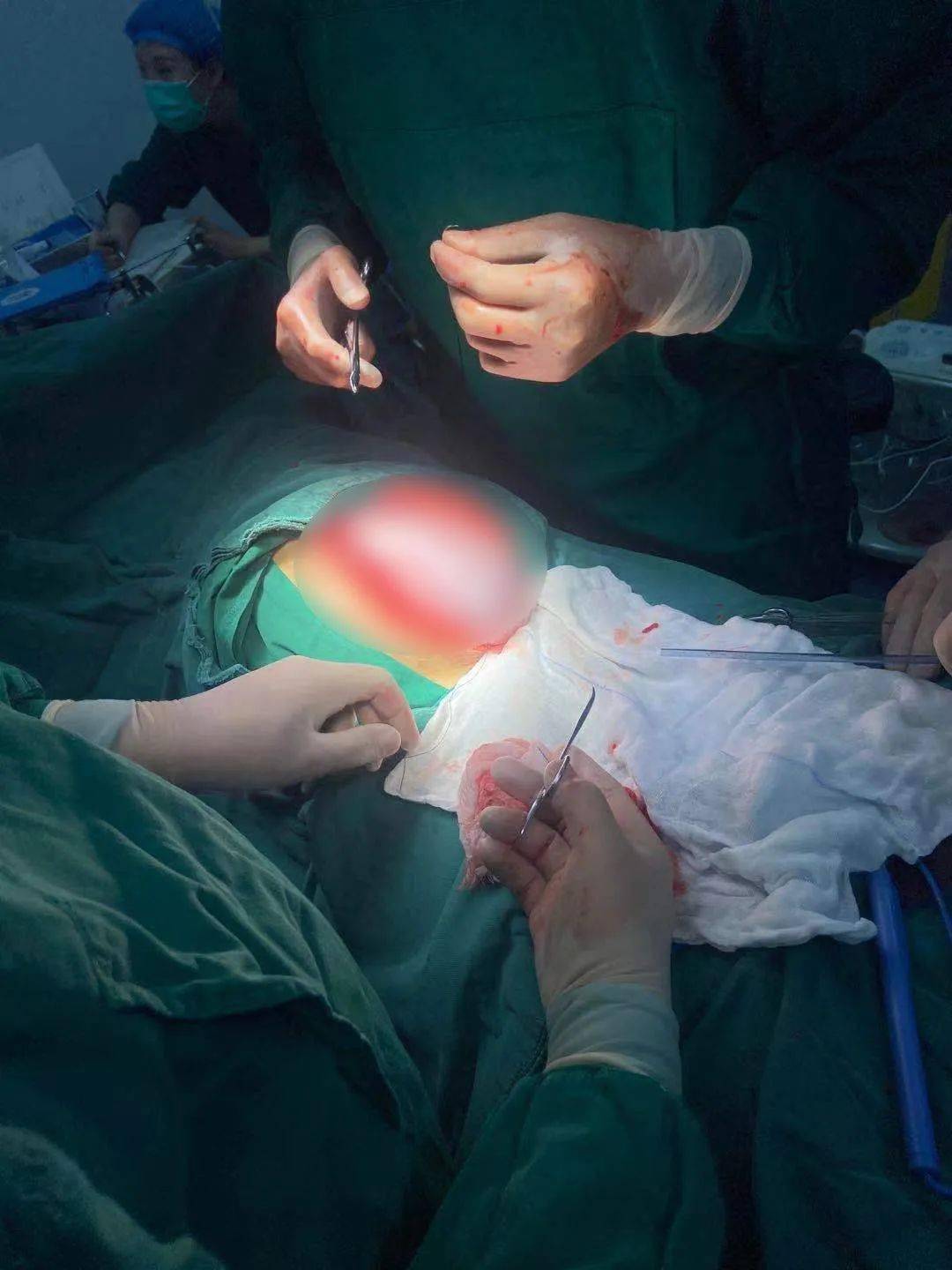 慈海急救中心普外科成功开展一例西瓜大囊腺瘤切除手术