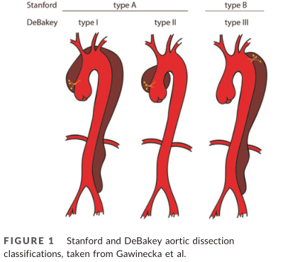 主动脉夹层stanford图片