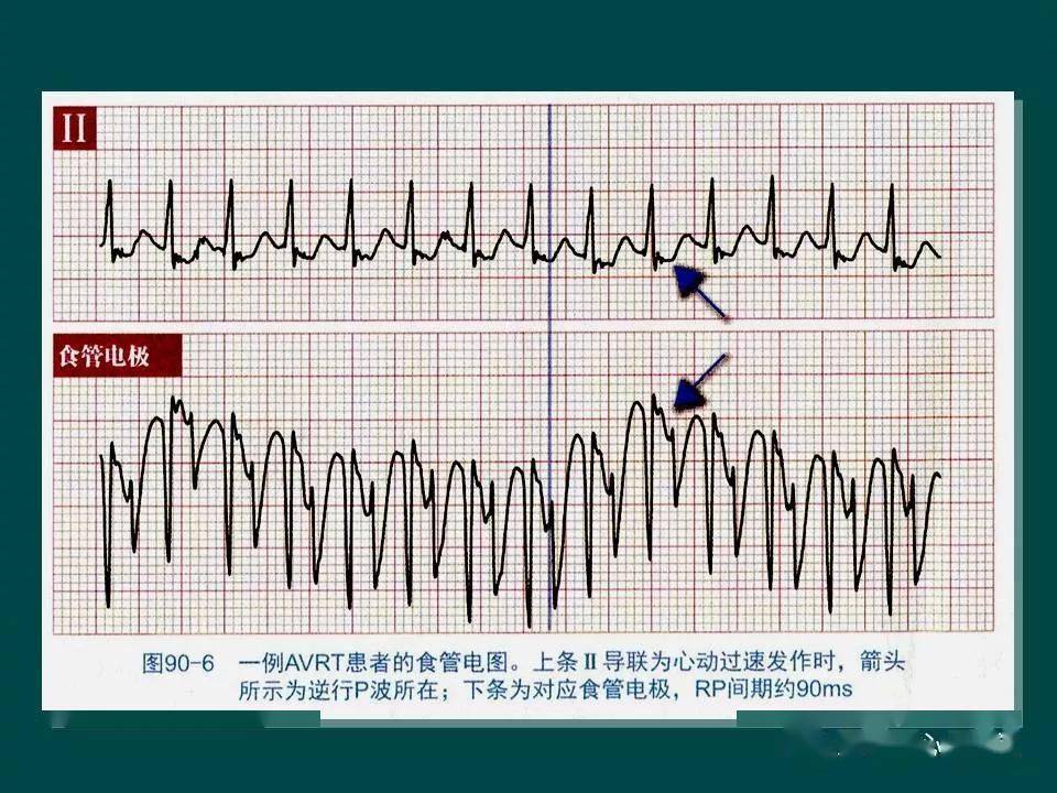 一文搞定 | 预激综合征