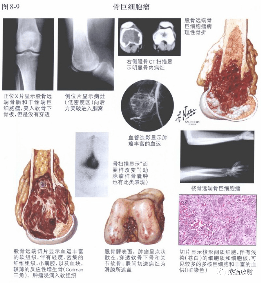 奈特图解丨骨骼肌肉系统肿瘤和相关瘤样病变