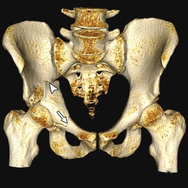 髂骨骨翼骨折图片
