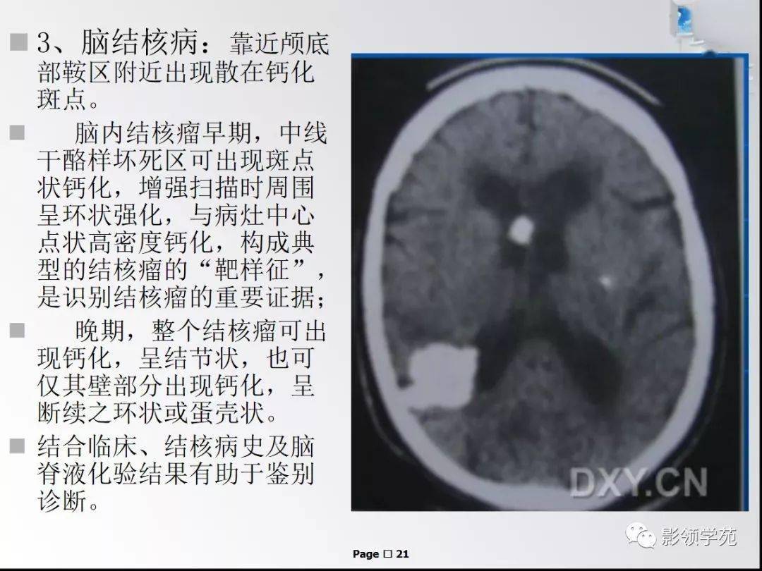 顱內鈣化性病變