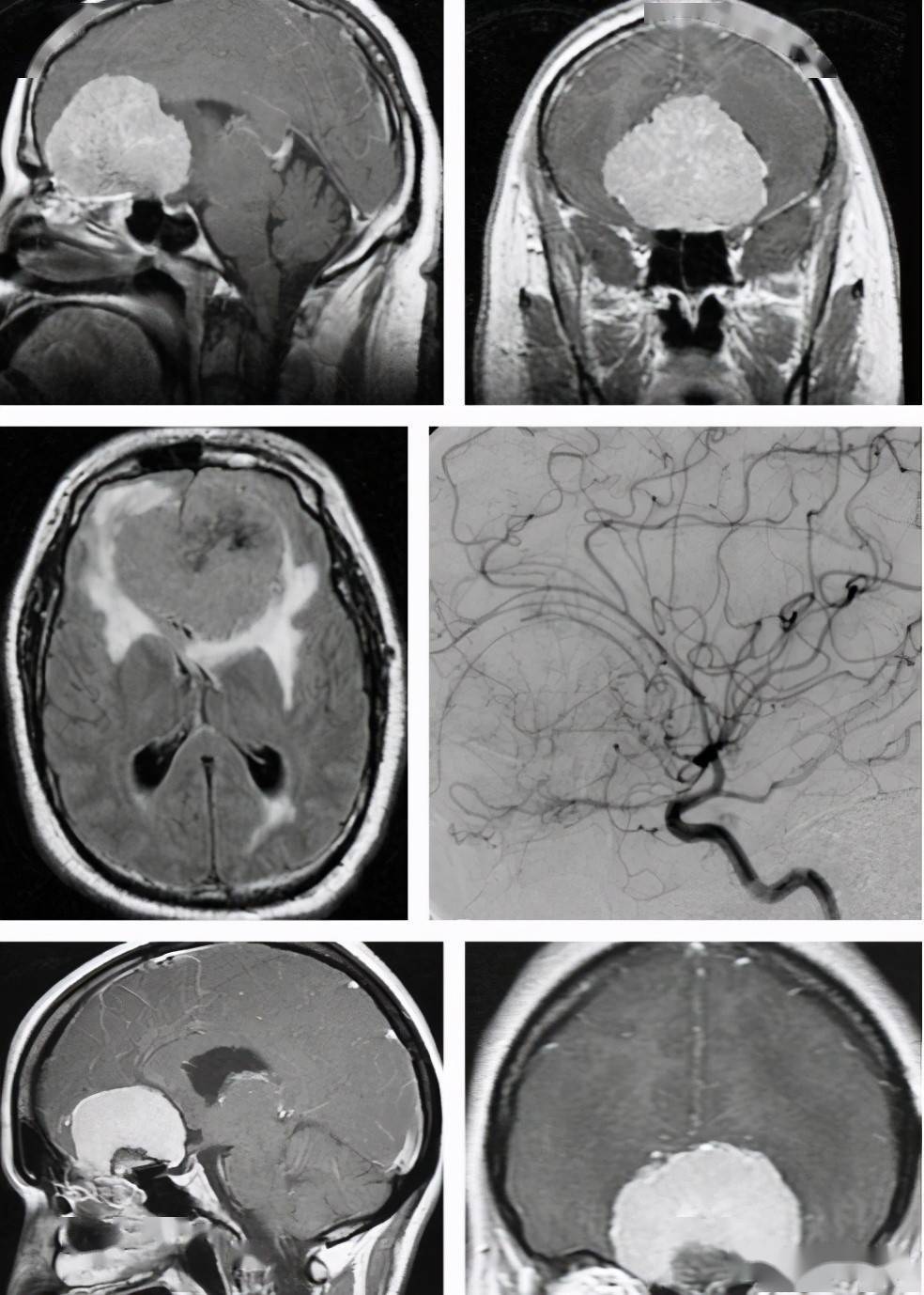 嗅沟脑膜瘤手术策略与技巧