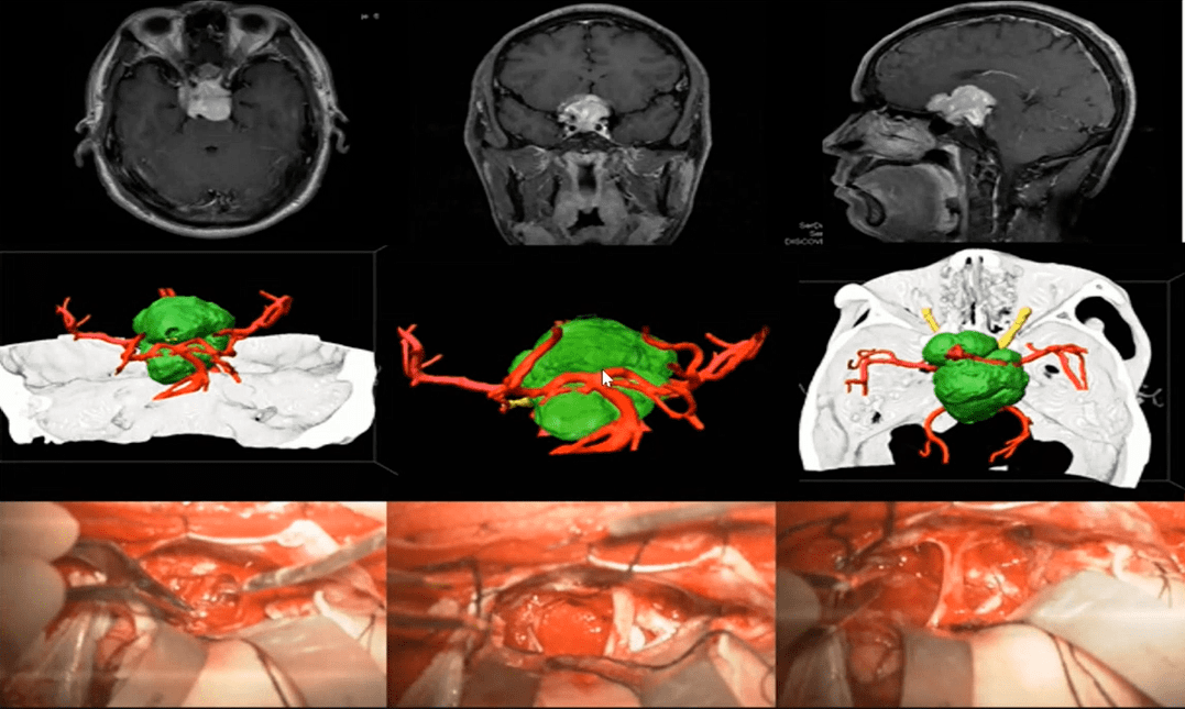 特别是在大脑左侧是不是出现语言的问题,语言的障碍;通过三维重建技术