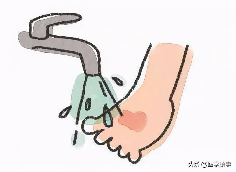 常在厨房走，哪能不伤手……烫伤该如何处理？