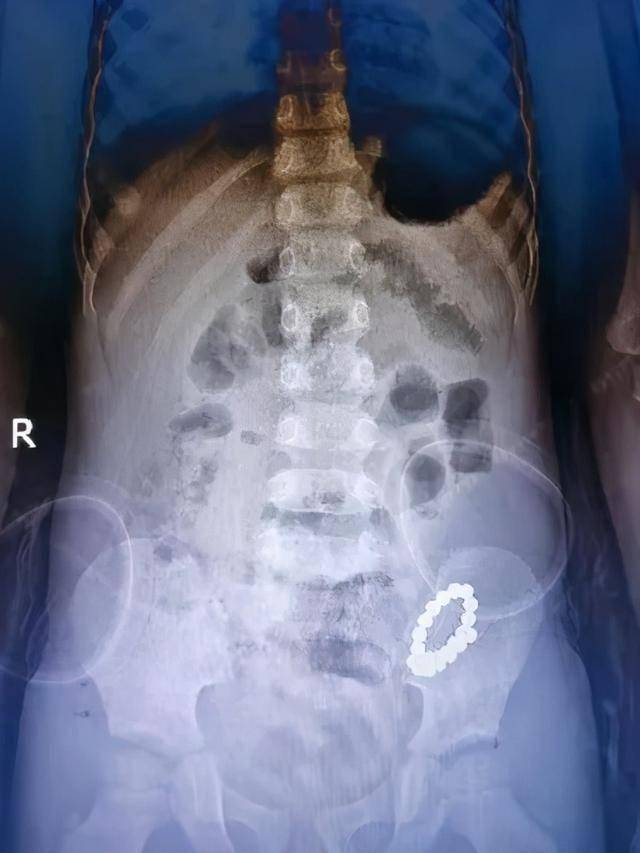 肠穿孔x线表现图片