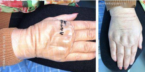 甘露醇外渗:护理高手总结6大预防措施,1 大处理妙招,太好用了