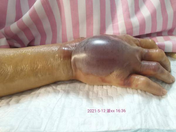 右上肢感染,脓毒症,脓毒性休克,肺炎,呼吸衰竭等症状,之后被送往医院