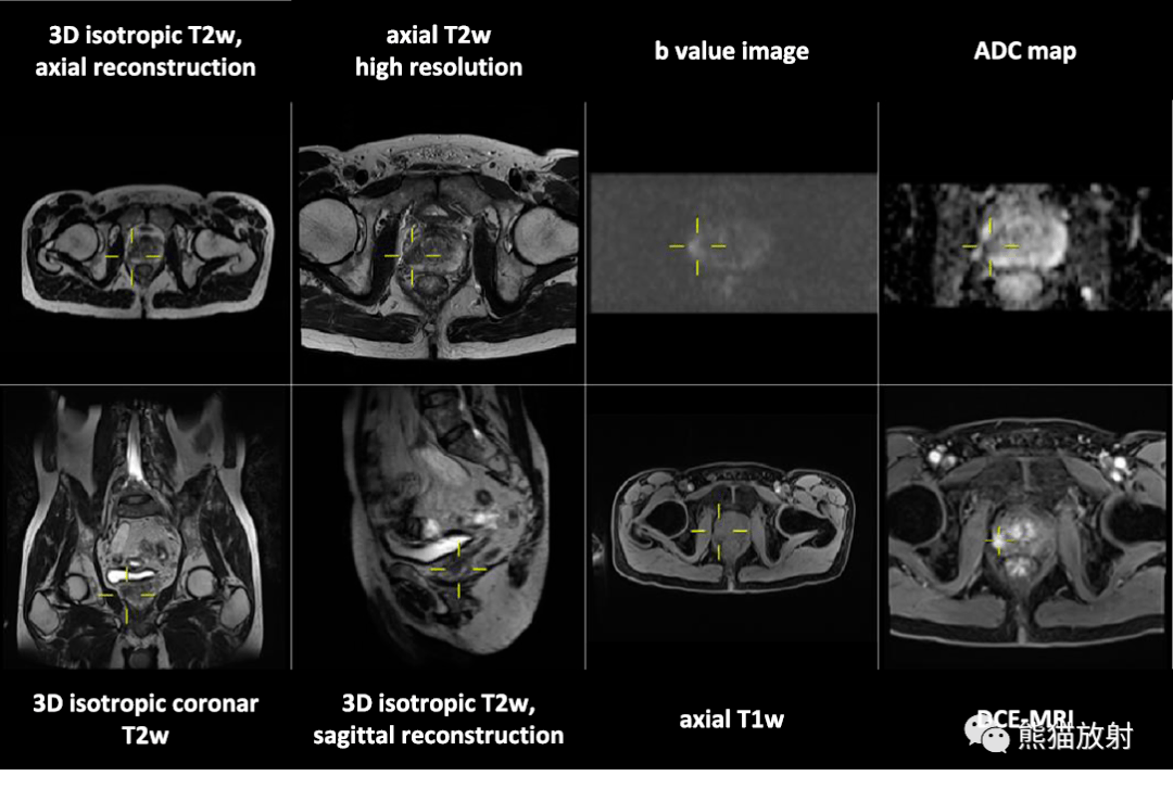 pirads前列腺影像报告和数据系统