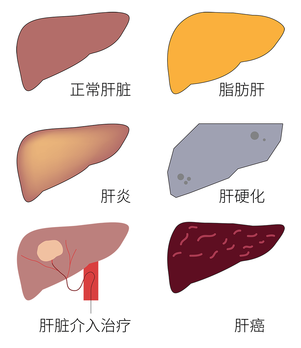 【片仔癀之友】患有脂肪肝的人越來越多,出現哪些症狀可能要警惕?