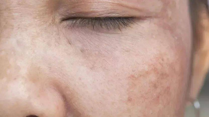 皮肤不长斑,是怎么做到的?_黑色素