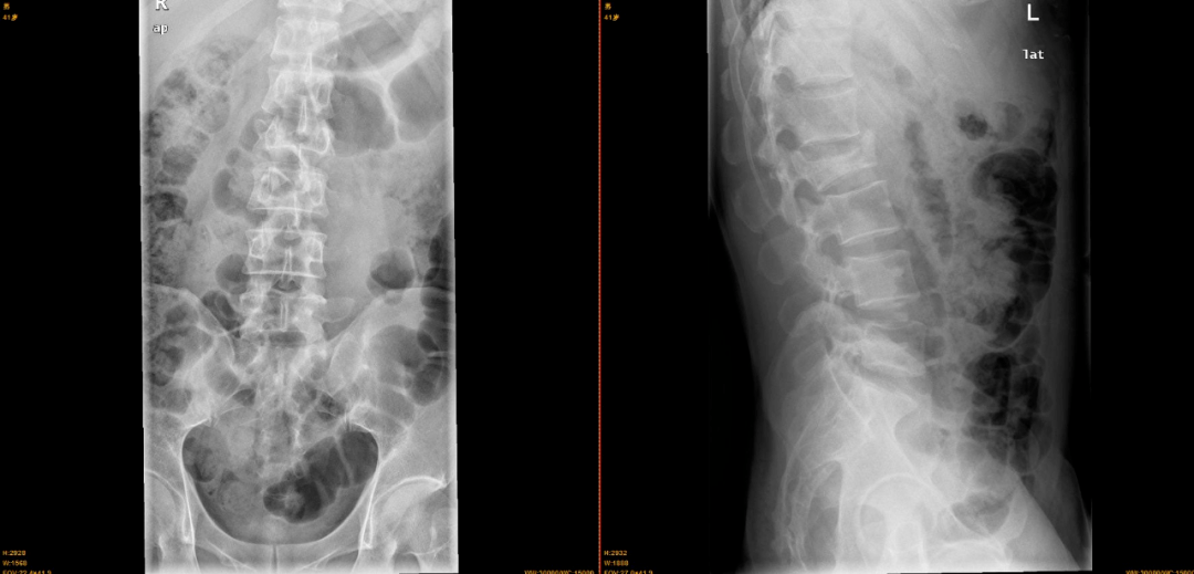 【大病不出县●断骨归位】我院脊柱外科常态化手术治疗腰椎爆裂性骨折