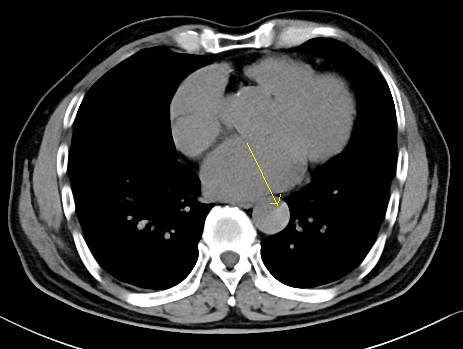 经典图谱ct平扫诊断主动脉夹层