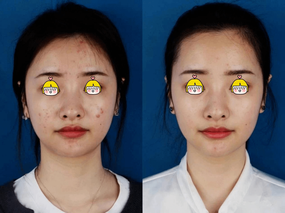 果酸换肤让您的肌肤焕然一新