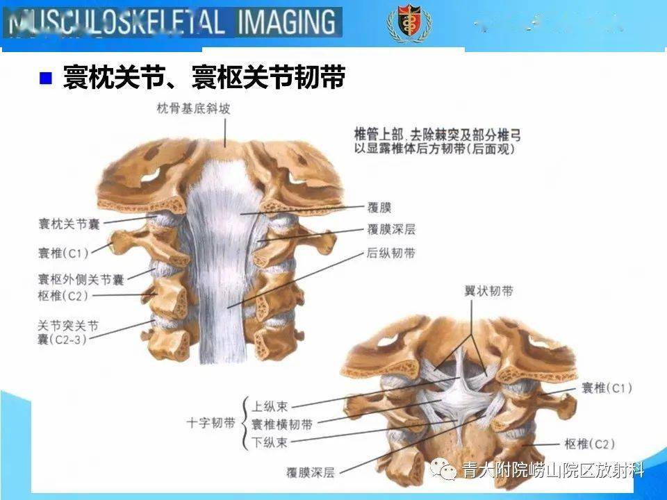 jefferson骨折_放射科