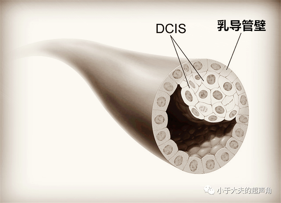 ductalcarcinoma图片