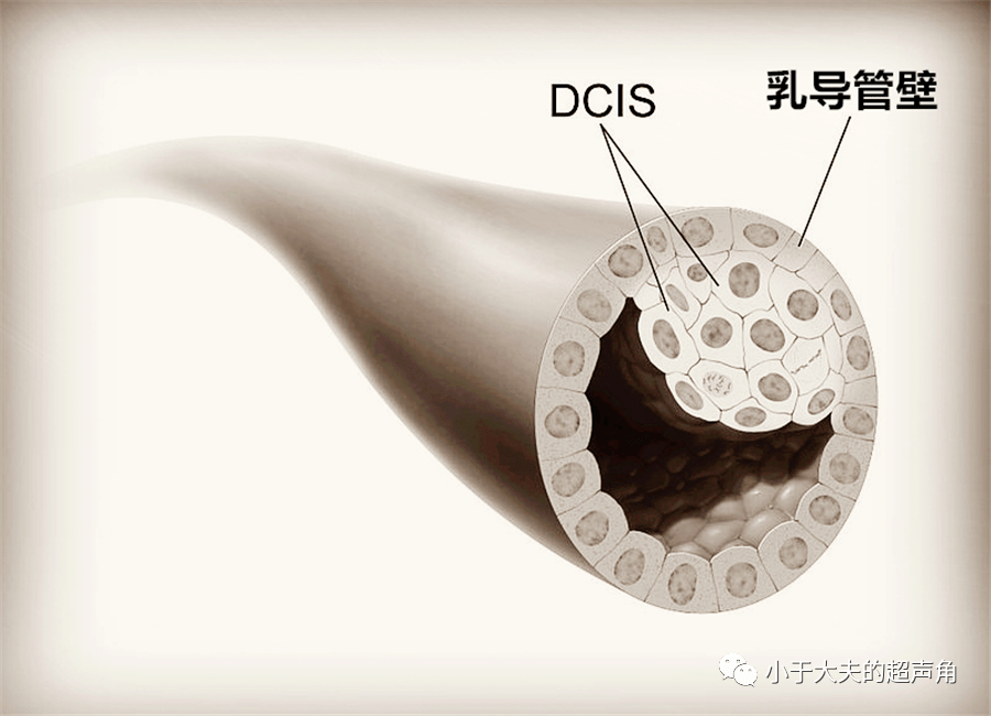 超声随响第77期导管原位癌dcis粉刺癌最具代表性的导管原位癌