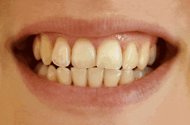 解决你的笑容尴尬症_牙齿