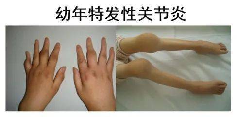 (1) 风湿性疾病:川崎病,过敏性紫癜,幼年特发性关节炎,系统性红斑狼疮