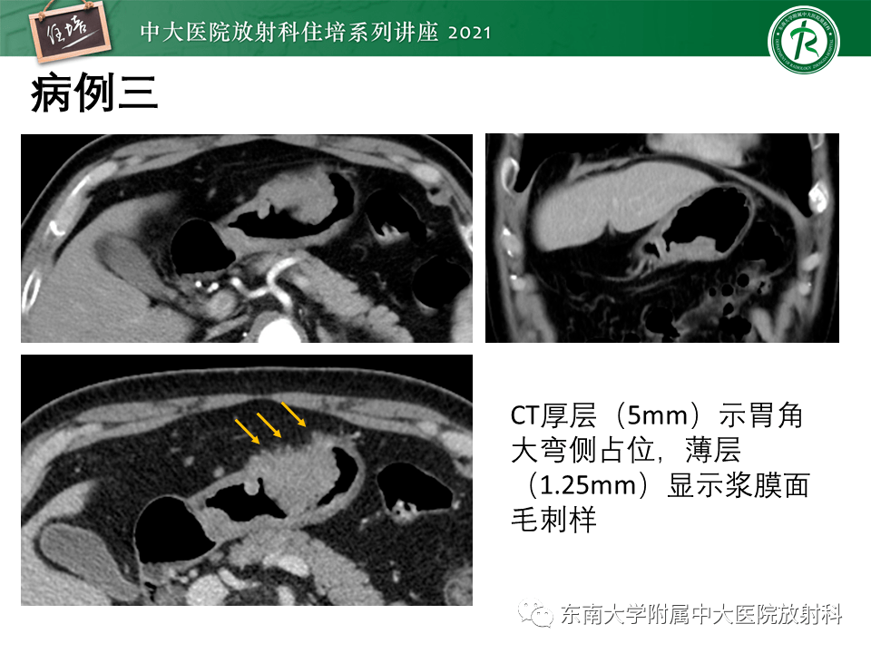 ajcc第8版胃癌tnm分期解讀及影像學評估_解剖圖