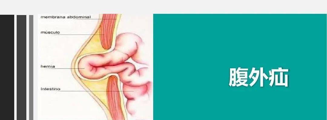 其实是一个腹外疝,郑老伯长的这个"球,王煜环来说一说听区人民医院医