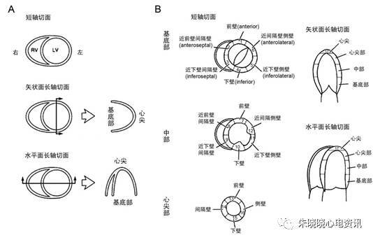 急性正后壁心肌梗死心电图