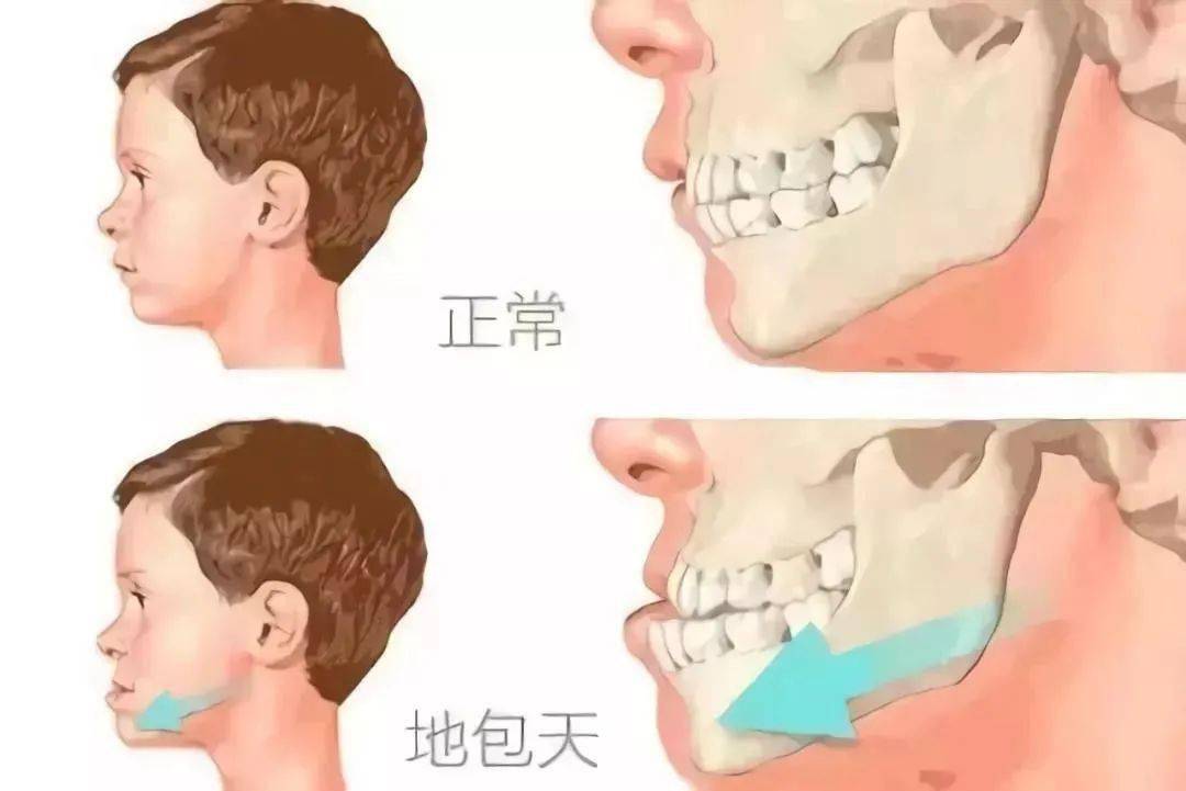 我们俗称的"地包天"医学上叫做牙齿反颌.