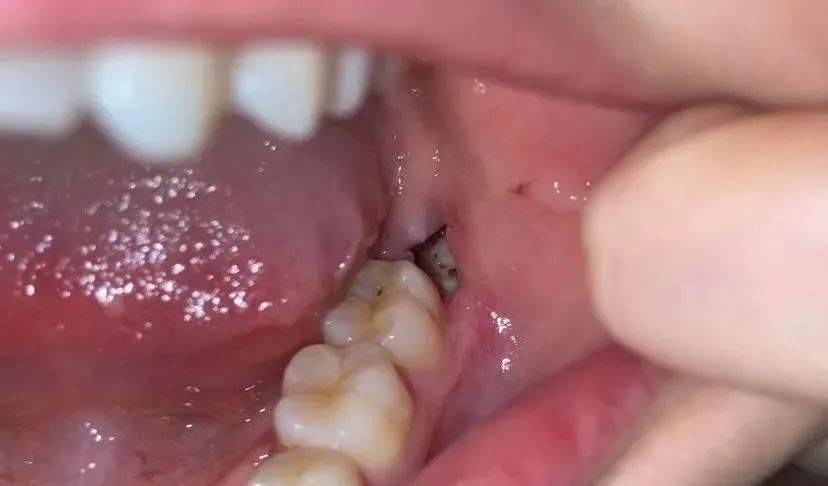 梦见自己掉了很多牙齿却没血不疼痛，潜意识深处的预兆与解析