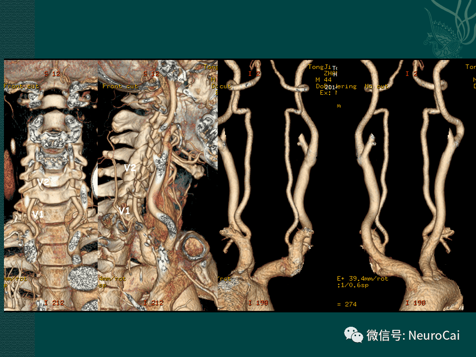 高清圖腦動脈解剖與ct重建