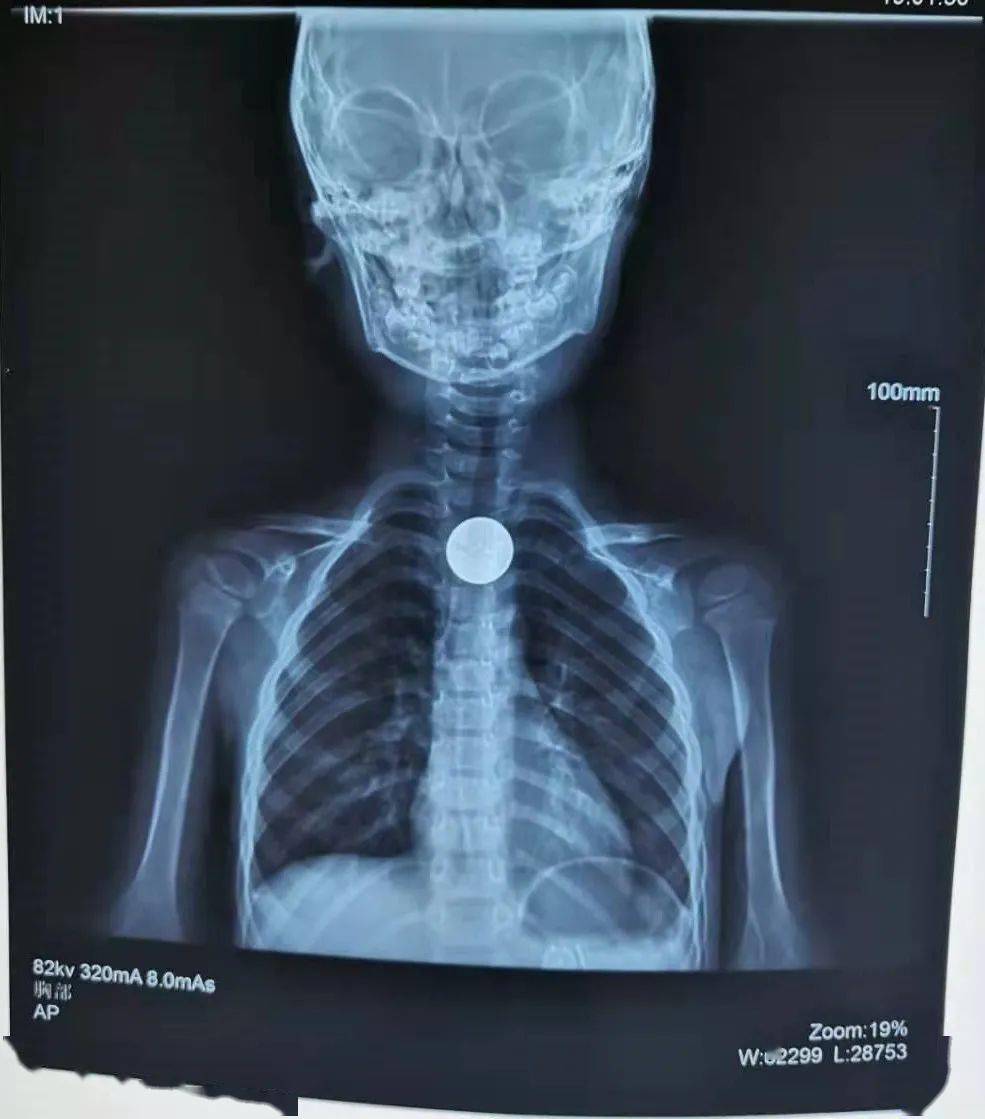 立即送往泗阳县中医院就诊硬币卡在小明食道内拍摄的x光片清晰显示