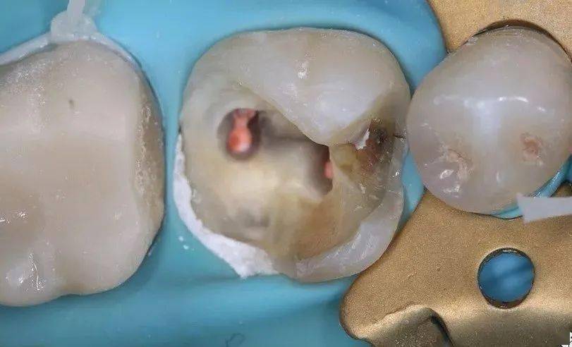 急性牙髓炎一次性根管充填和多次根管治疗后充填哪个好?