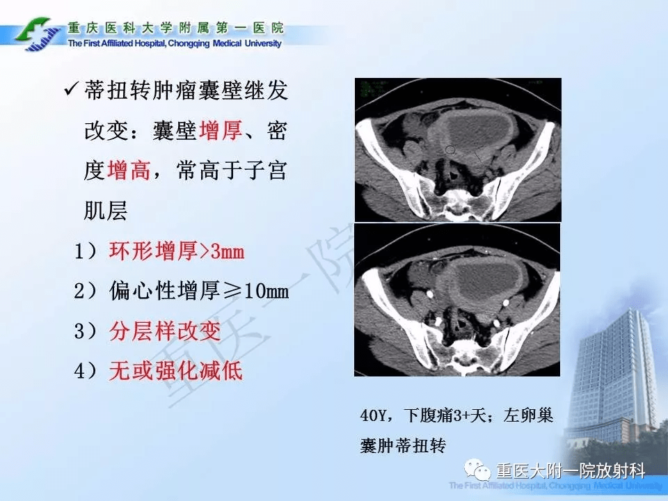 卵巢肿瘤蒂扭转的ct诊断