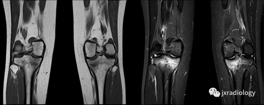 骨性关节炎(oa):男,58岁,股骨内侧髁负重区有软骨缺损,伴有边缘小骨赘