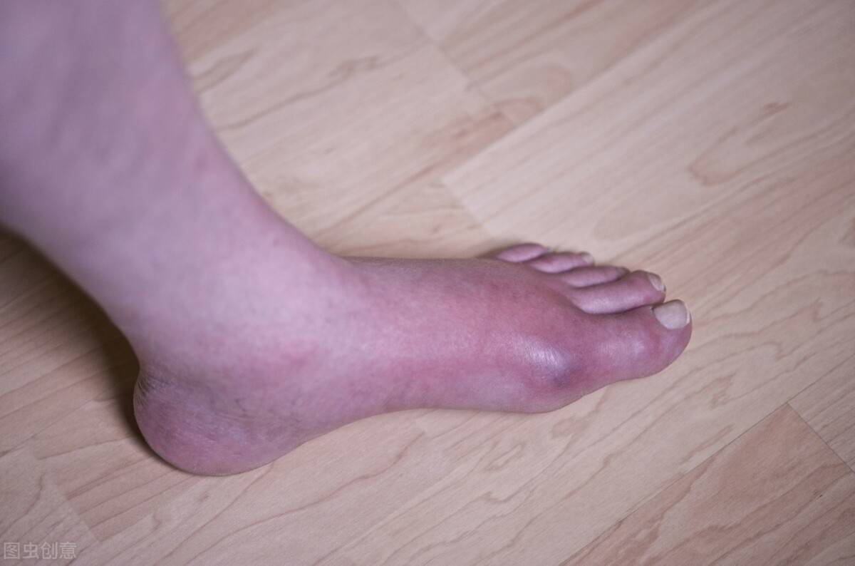 错把关节炎当痛风?别再傻傻分不清,他们有5大区别的